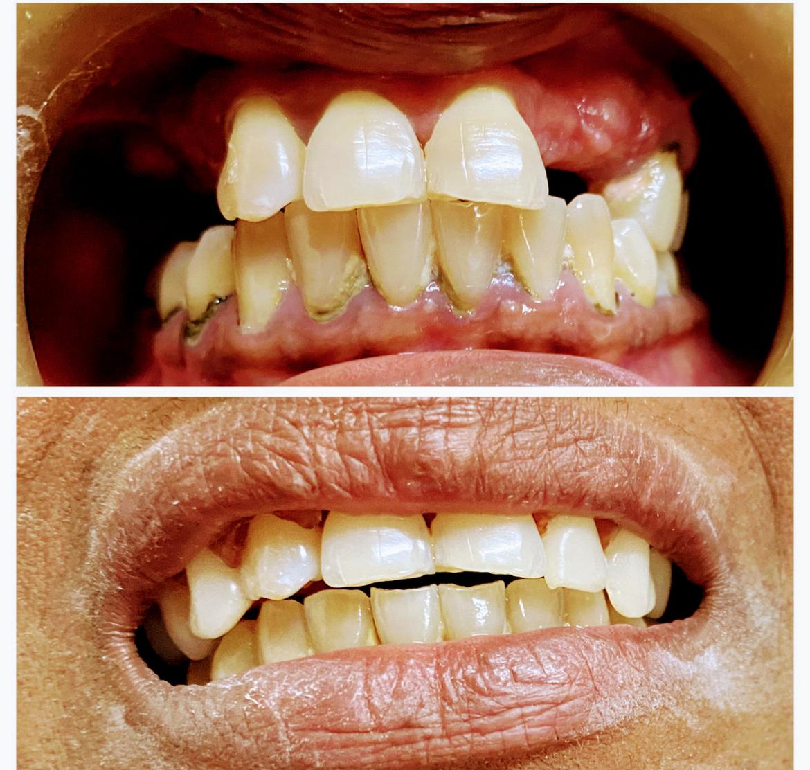 Gum Treatment